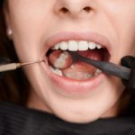 How often do fillings need to be replaced?