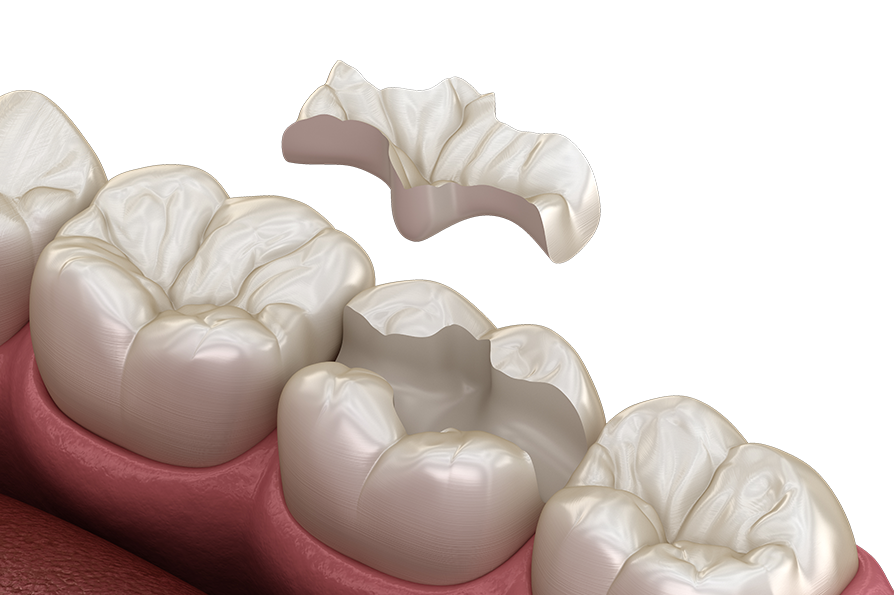 Ceramic Restorations