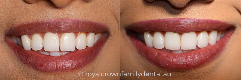 Composite veneers