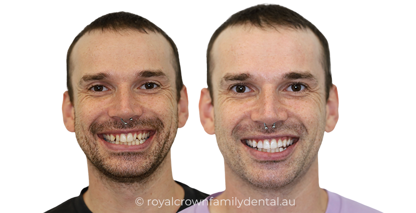 Composite veneers