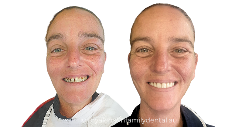 Full upper set of porcelain veneers