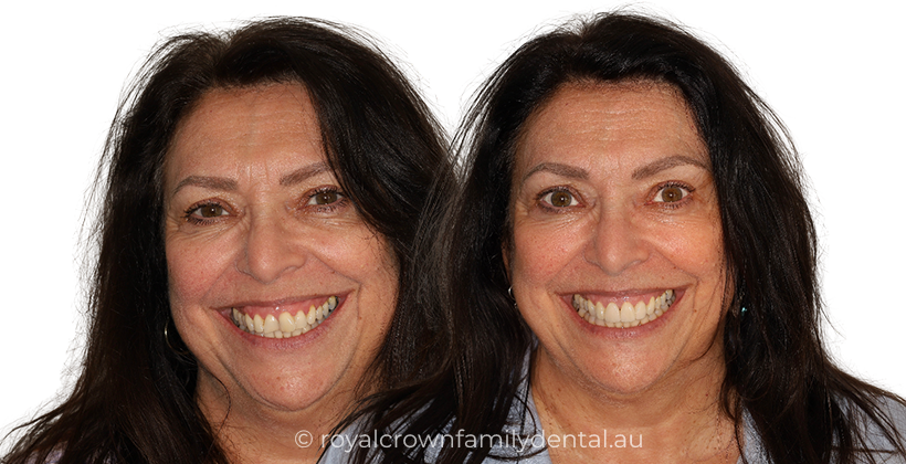 Porcelain Veneers for Crowding