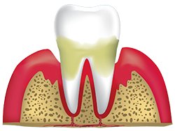 Periodontitis