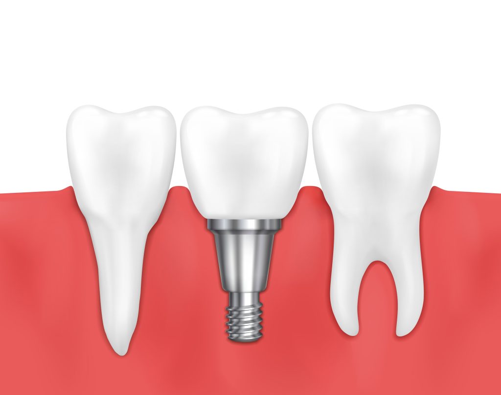 Dental Implant